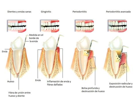 enfermedad periodontal-1